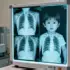 AI Breakthrough for Pediatric TB Diagnosis Shows Promise